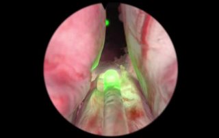 Green Light Laser Prostatectomy