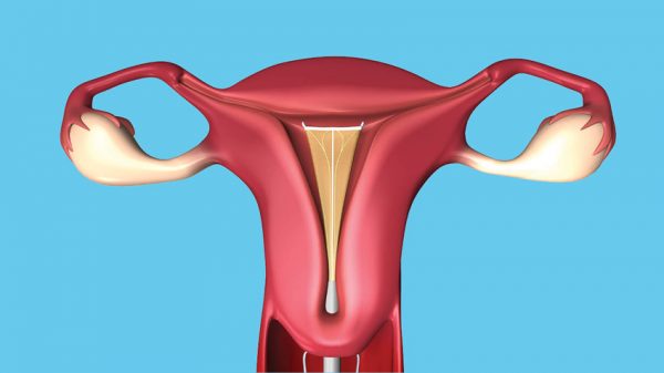 Microwave Endometrial Ablation - Medithics Blog