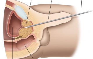 Trans Urethral Resection of Bladder Tumour (TURBT)