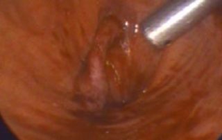 Ureteric Reimplantation
