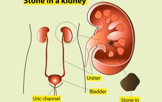 Kidney Stone doctor kolkata