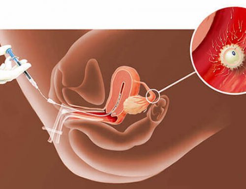 Intrauterine insemination: An Overview