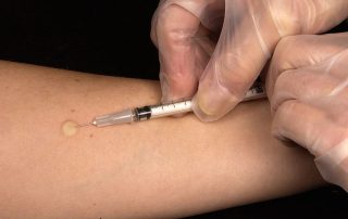 tuberculin-skin-test
