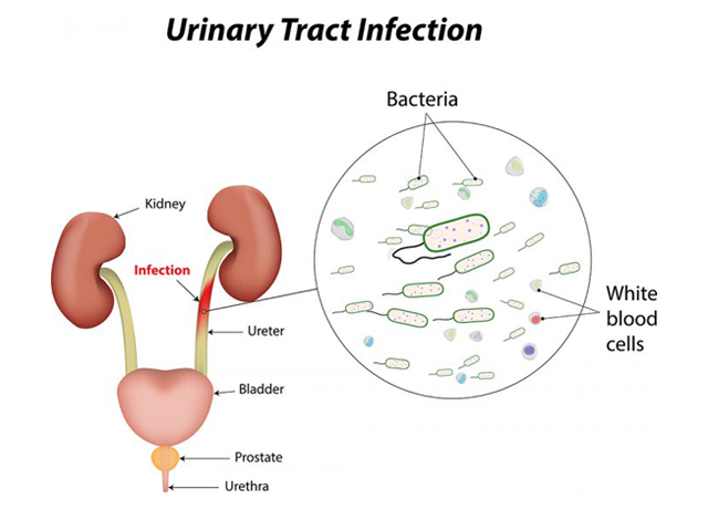 Recurrent Urinary Tract Infections