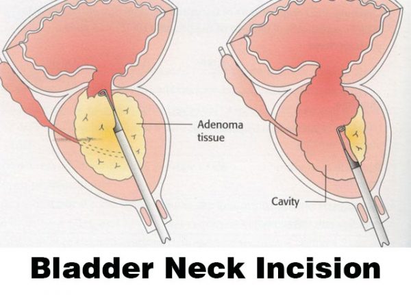 Bladder Neck Incision