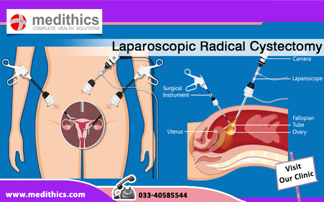 Laparoscopic Radical Cystectomy