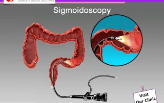 Sigmoidoscopy