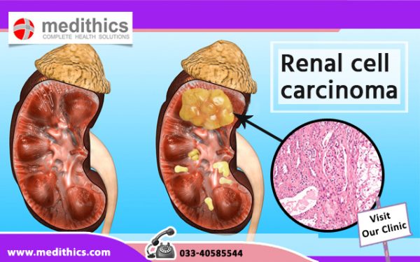 initial presentation of renal cell carcinoma