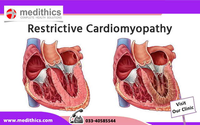 Restrictive Cardiomyopathy